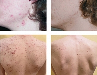 Рис. 4. Результаты лечения acne vulgaris у пациента 22 лет (период наблюдения – 12 недель)