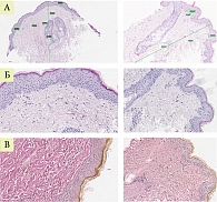 Рис. 5. Гистологическая картина у пациентки В. до и после лазерной терапии (А, Б – ГЭ, В – В-Г)