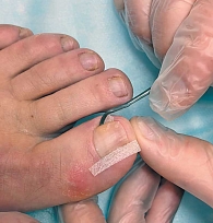 Рис. 5. Тампонада околоногтевых пазух тонким кополином