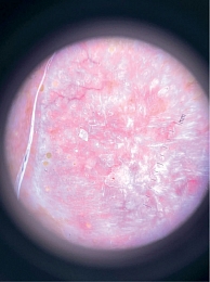 Рис. 9. Поляризованная дерматоскопия: белые структуры (по типу «хризалид») на месте рубца