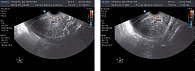 Рисунки 1, 2. Трансвагинальное сканирование. Участки повышенной эхогенности, гипо- и анэхогенные участки в миометрии до лечения