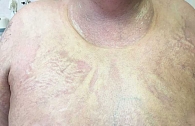 Рис. 1. Пансклеротическая склеродермия. Поражение кожи туловища в виде «панциря»
