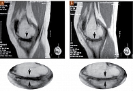 Рис. 3. МРТ коленного сустава пациента К. исходно (А) и через 12 месяцев терапии Алфлутопом (Б)