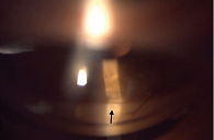 Рис. 5. Результат ЛДГП в области проведения НГСЭ при гониоскопии правого глаза