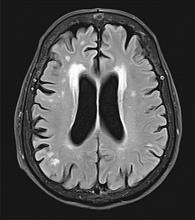 Рис. 1. Единичные очаговые изменения белого вещества головного мозга, лейкоареоз у передних рогов боковых желудочков по типу «шапочек» (МРТ-изображение в режиме Т1)