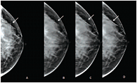 Рис. 2. Пациентка В., 37 лет. Маммограммы правой молочной железы, киста. 2D- (A)  и 3D-изображения (B, C, D – послойные)