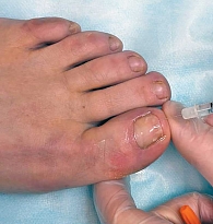 Рис. 2. Аппликация 25%-ного раствора диметилсульфоксида (Димексид)