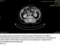 Рис. 2. МСКТ органов брюшной полости с внутривенным контрастированием (ультравист) от 03.04.2023: