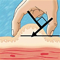 Рисунок 5. Угол введения иглы при подкожной инъекции (инсулин, Баета)