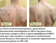 Рис. 4. Пациент 22 года, тяжелая степень тяжести акне на коже туловища (PGA = 4)