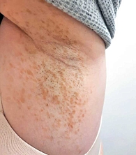 Рис. 3. Гиперпигментированные пятна в подмышечной впадине (фото из личного архива А.Г. Пашинян)