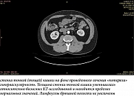 Рис. 3. МСКТ органов брюшной полости с внутривенным контрастированием (ультравист) от 13.05.25 (контроль):