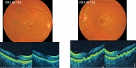 Рис. 4. Динамика прогрессирования ВМД с ранней стадией на правом глазу, промежуточной – на левом