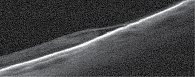 Рис. 3. ОКТ: щелевидная полость на уровне разрыва наружных слоев ретиношизиса на первые сутки