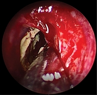 Рис. 7. Эндоскопическое интраоперационное фото: видна полость правой половины клиновидной пазухи, заполненная патологическим содержимым