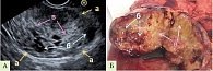 Рис. 1. Солидная псевдопапиллярная опухоль: А – эндосонограмма,  Б – макропрепарат (а – наружный контур новообразования,  б – кистозные полости, в – солидные структуры)