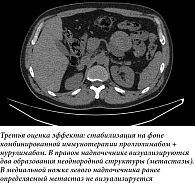 Рис. 3. Компьютерная томограмма органов брюшной полости с в/в контрастированием (ноябрь 2025 г.).