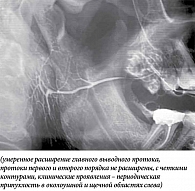 Рис. 2. Сиалограмма правой околоушной слюнной железы пациентки Б. 46 лет, суммарная введенная активность I-131 – 3,1 ГБк