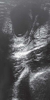 Рис. 1. Эхограмма правостороннего мастита у 12-летней девочки