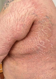 Рис. 3. Пансклеротическая склеродермия. Крупные очаги индурации на туловище, множественные стрии, участки атрофии кожи