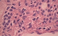 Рис. 2. Пролиферация дуктул, перигепатоцеллюлярный фиброз на фоне жировой инфильтрации печени (1200-кратное увеличение)
