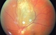 Метастаз меланомы кожи в сосудистую оболочку глаза
