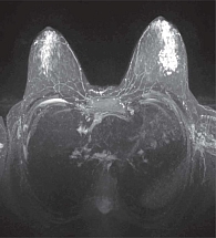 Рис. 7. МРТ с контрастным усилением: фиброзно-кистозная мастопатия у 17-летней пациентки