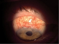 Рис. 2. Фильтрационная подушка на правом глазу в диффузном освещении