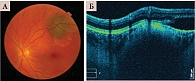 Рис. 6. Офтальмоскопия (A) и томограмма (Б) меланомы хориоидеи
