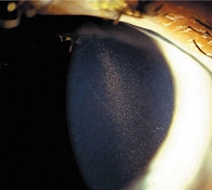 Рис. 2. Веретено Крукенберга (скопление на эндотелии роговицы, преимущественно в центральном ее отделе, пигмента из радужки в форме вертикально расположенного столбика) при синдроме пигментной дисперсии и пигментной глаукоме