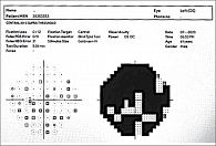 Рис. 8. iVA. 30–2. Пациент 2, левый глаз: концентрическое сужение поля зрения с сохранением единичных островков