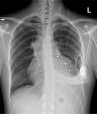 Рис. 2. Рентгенограмма органов грудной клетки, октябрь 2024 г.