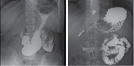 Рис. 2. Рентгенограммы отдавливания желудка  без нарушения транзита; дискинезия двенадцатиперстной кишки по гипертоническому  типу со спастическим компонентом