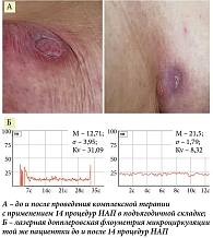 Рис. 3. Синдромальная форма ГП (у пациентки Г. артрит и пустулезный псориаз Цумбуша):