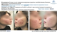 Рис. 5. Клинический пример пациентки с диагнозом «акне тяжелой степени тяжести; IGA = 4 балла» (из презентации члена-корр. РАН, д.м.н., проф. О.Ю. Олисовой  и д.м.н., проф. Е.С. Снарской)