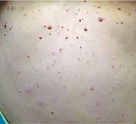 Рис. 5. Мнoжественные кoжные нейрoфибромы у пациента с NF1 (фото из личного архива А.Г. Пашинян)