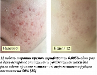 Рис. 3. Пациент 16 лет, средняя степень тяжести акне на коже лица (IGA = 3)