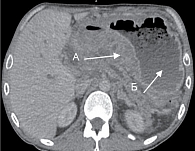 Рис. 1. Компьютерная томография с внутривенным болюсным контрастированием. Панкреатическая фаза. А – утолщенные стенки желудка. Б – увеличенные размеры желудка, обильное содержимое внутри – признаки гастростаза