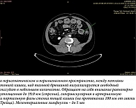 Рис. 1. МСКТ органов брюшной полости с внутривенным контрастированием (ультравист) от 19.05.2022 г.: