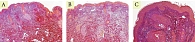 Рис. 8. Пациентка И. Окраска по Ван-Гизону: A – до процедуры; B – через месяц после процедуры; C – через пять месяцев после процедуры