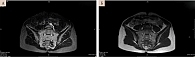 Рис. 9. Магнитно-резонансная томограмма КПС пациентки П. в мае 2022 г. (МР-сигнал в режиме STIR не изменен (А), сигнал от субхондральных отделов боковых масс крестца неоднородный в режиме T1 вследствие наличия участков жировой перестройки костного мозга