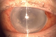 Рис. 2. Наличие гипопиона, отсутствие рефлекса с глазного дна при эндофтальмите