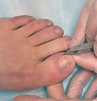 Рис. 4. Малоинвазивная резекция вросшего сегмента щипцами для коррекции онихокриптоза