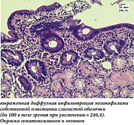 Рис. 1. Гистологическое исследование биоптатов ДПК: