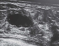 Рис. 13. Эхограмма галактоцеле правой молочной железы у пятилетней девочки