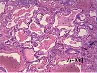 Рис. 2. Больной П.: фиброз межальвеолярных перегородок  с образованием микросот.  Окраска гематоксилином и эозином. ×40.