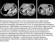 Рис. 7. МСКТ от 26.01.2021. Состояние после правосторонней гемигепатэктомии, холецистэктомии