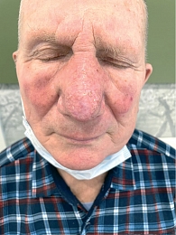 Рис. 7. Общий вид лица пациента спереди через 12 месяцев после первого сеанса ФДТ:  нос имеет естественную анатомическую форму, обычную окраску, на коже кончика носа – рубцовый дефект белесоватого цвета