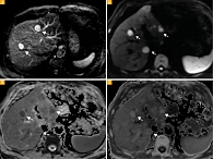 Рис. 3. Метастазы увеальной меланомы в печени: на диффузионно-взвешенных изображениях (DWI) с b-фактором 50  (А – сигнал от очагов гиперинтенсивный) и 1000 (Б – сигнал от очагов гиперинтенсивный)