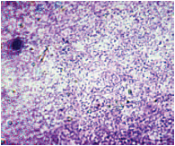 Рис. 2. Бактериальный вагиноз (микроскопия мазка, окрашенного по Граму)